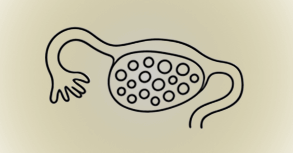 PCOS_illusztráció 02